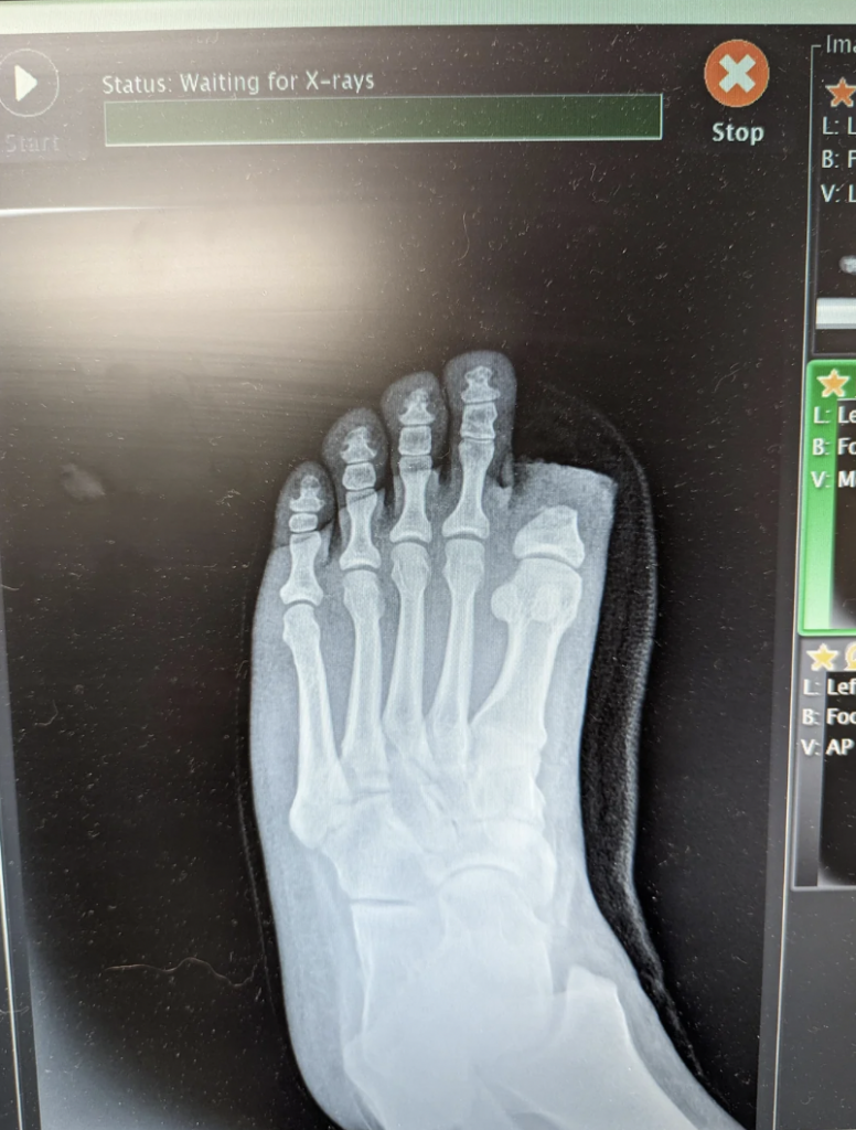 An X-ray image of a right foot showing bones including phalanges, metatarsals, and tarsals. A digital screen interface is visible with a status message "Waiting for X-rays" at the top.