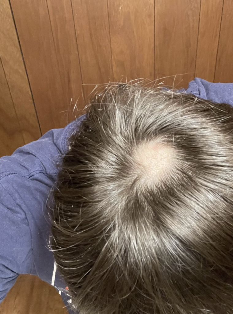 A top-down view of a person's head showing a round bald spot at the center of their scalp. The person has dark hair and is wearing a dark-colored shirt. The background consists of wooden panels.