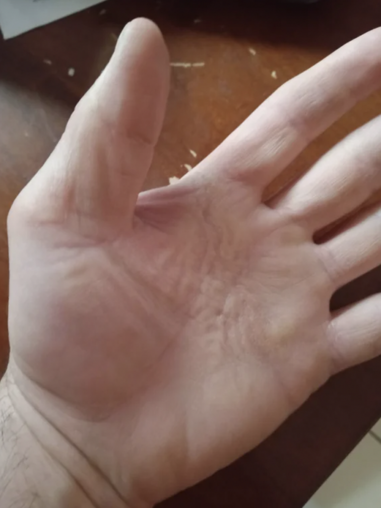 A close-up photo of an open hand with fingers spread apart, palm facing the camera. The skin on the hand appears slightly wrinkled, and there is a visible callus near the base of the middle finger. The background includes a wooden surface.