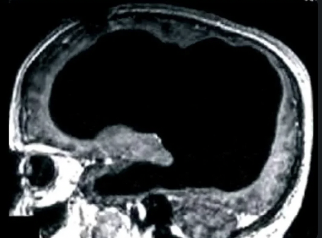 A black and white MRI scan of a human brain displays a large, dark area indicating significant cerebrospinal fluid accumulation or loss of brain tissue. The irregular shape spans a substantial portion of the image.