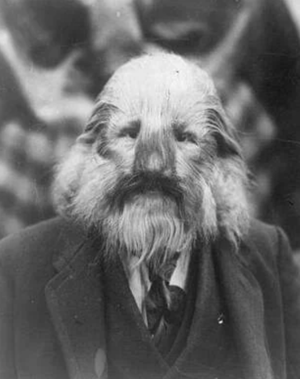 A black and white vintage photo of a person with a unique condition causing facial hair to grow densely across their entire face, giving an animal-like appearance. The individual is wearing a suit with a tie.