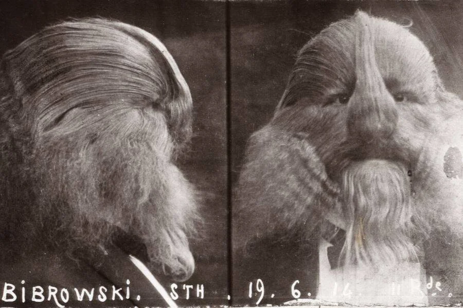 Black and white photo of a person with thick hair covering the entire face, including a beard-like pattern. The hair extends over the nose and eyes. The image is labeled with "Bibrowski" and a date.